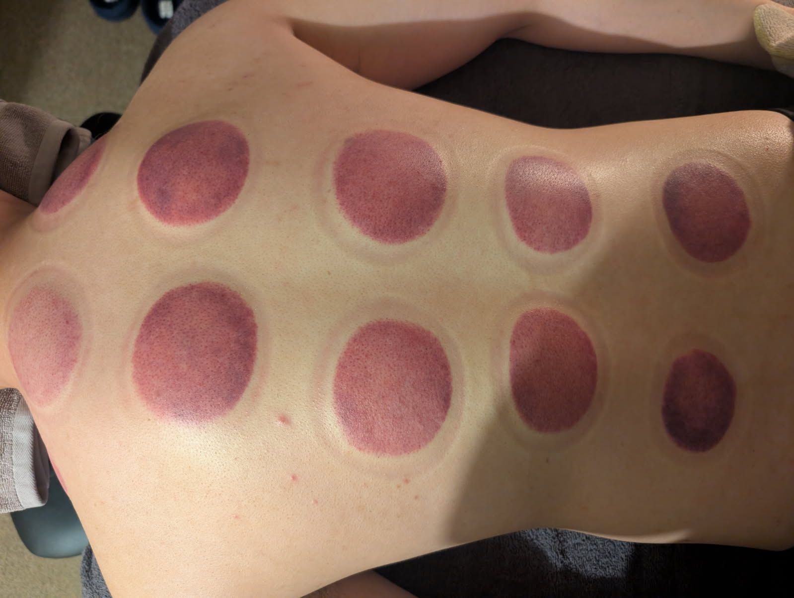 Cupping therapy marks on client's back after a bundle session